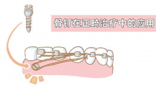 牙套和假牙的价格有没有区别,这些你应该知道！(图1)
